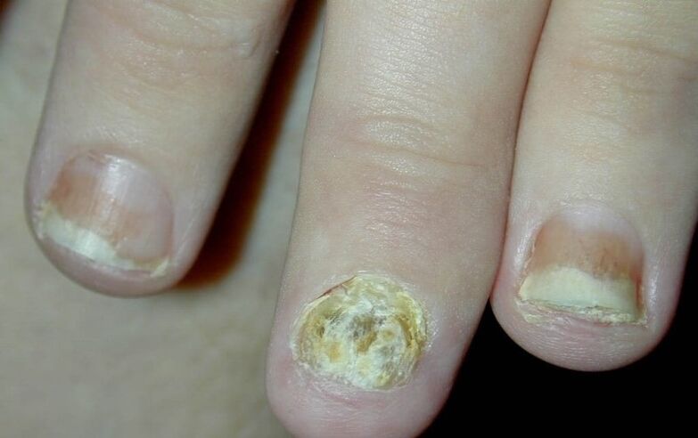 nail psoriasis on the hands