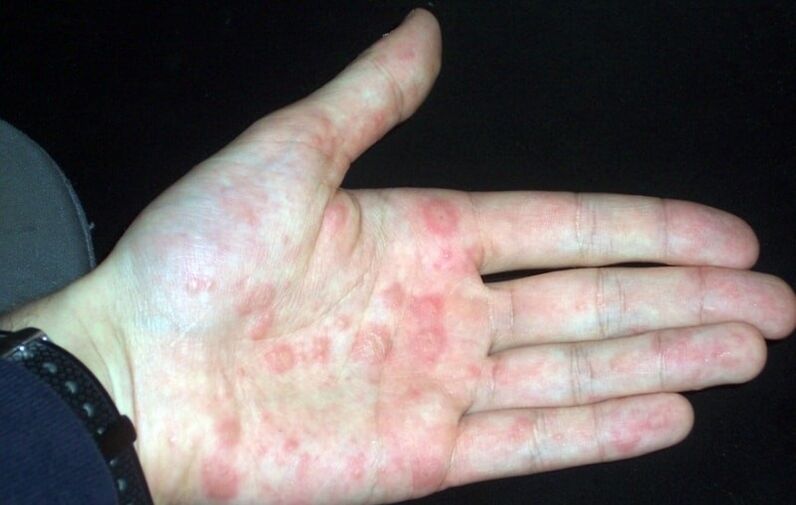 psoriasis in the plaque on the hands