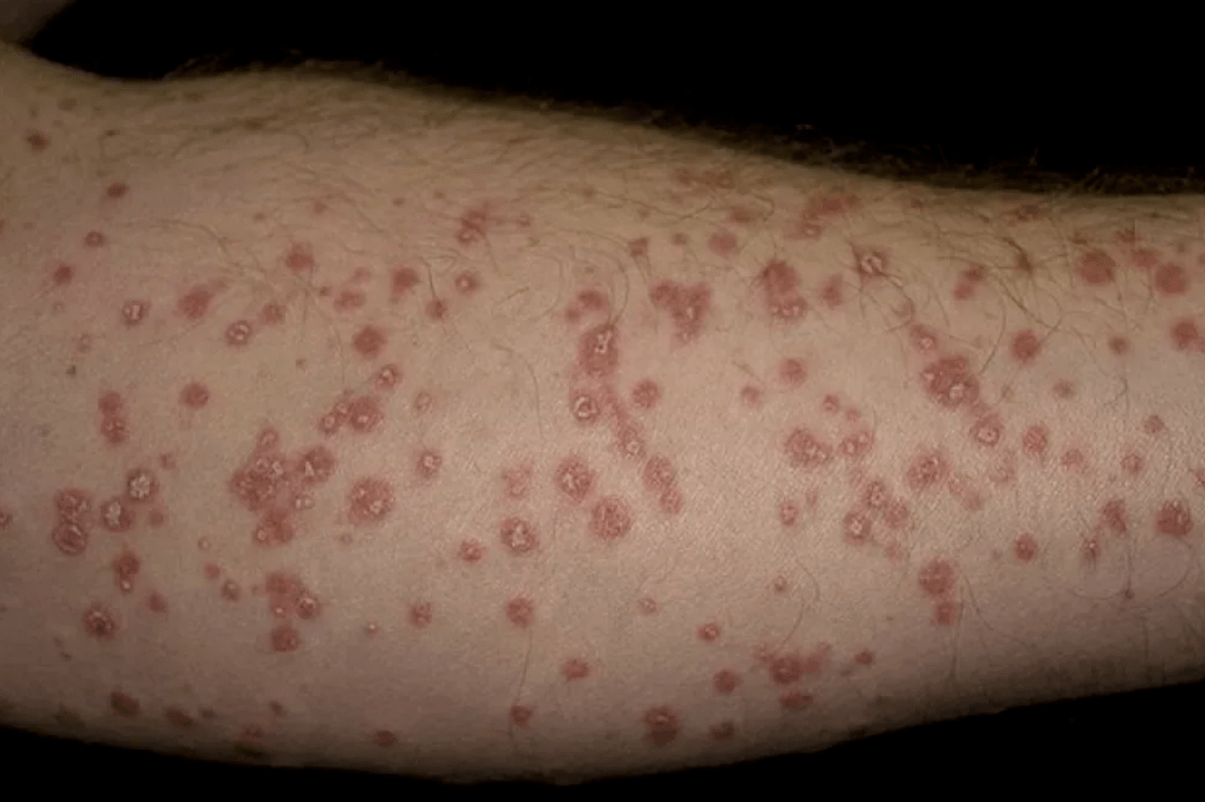 observed psoriasis