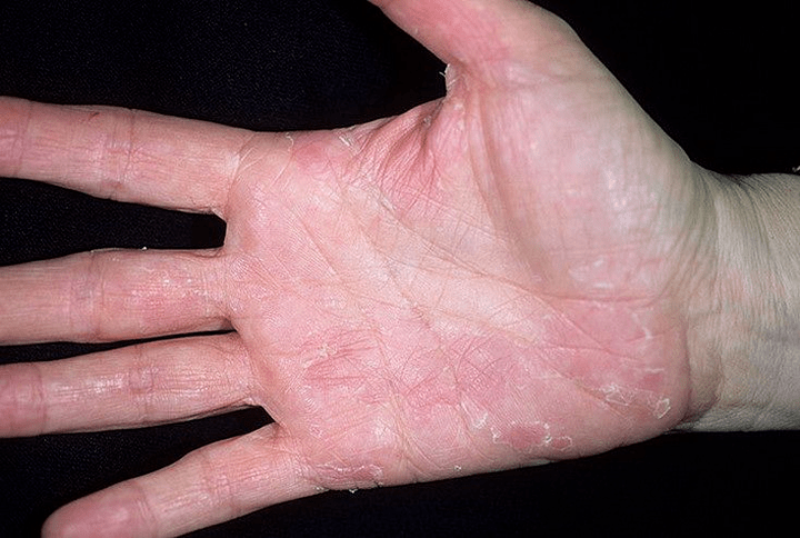 psoriasis of the palms and below them