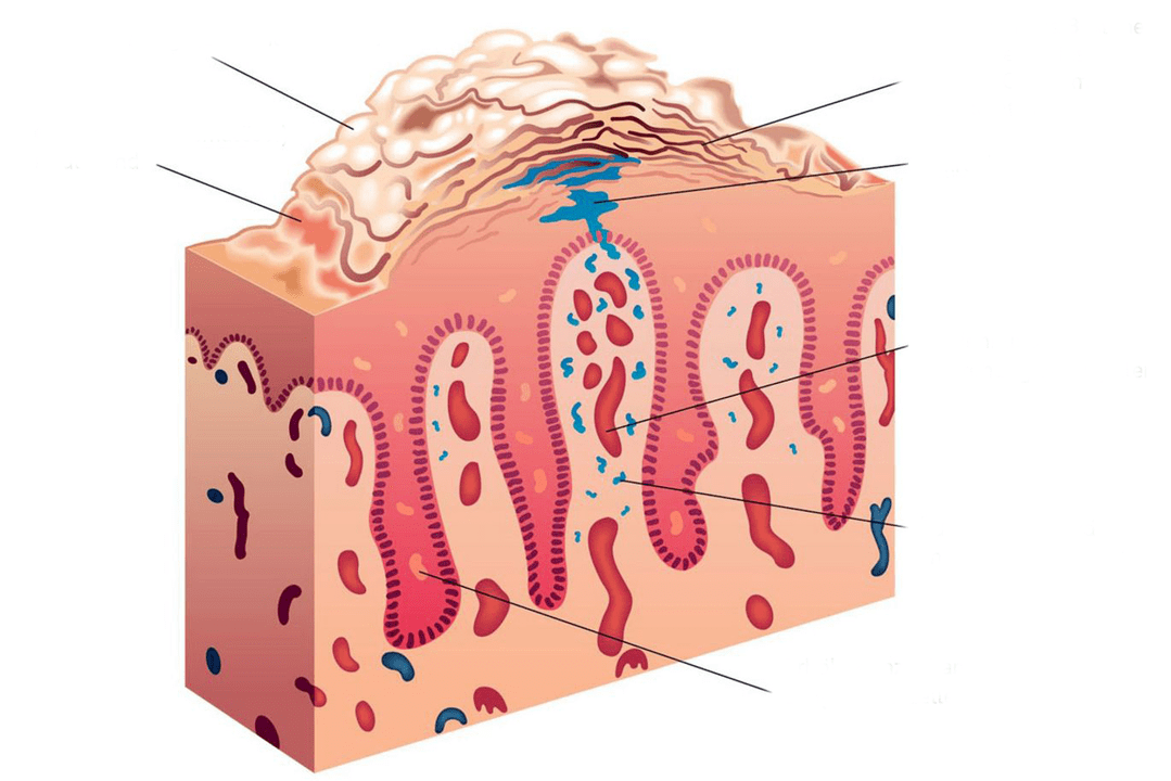 skin section in psoriasis