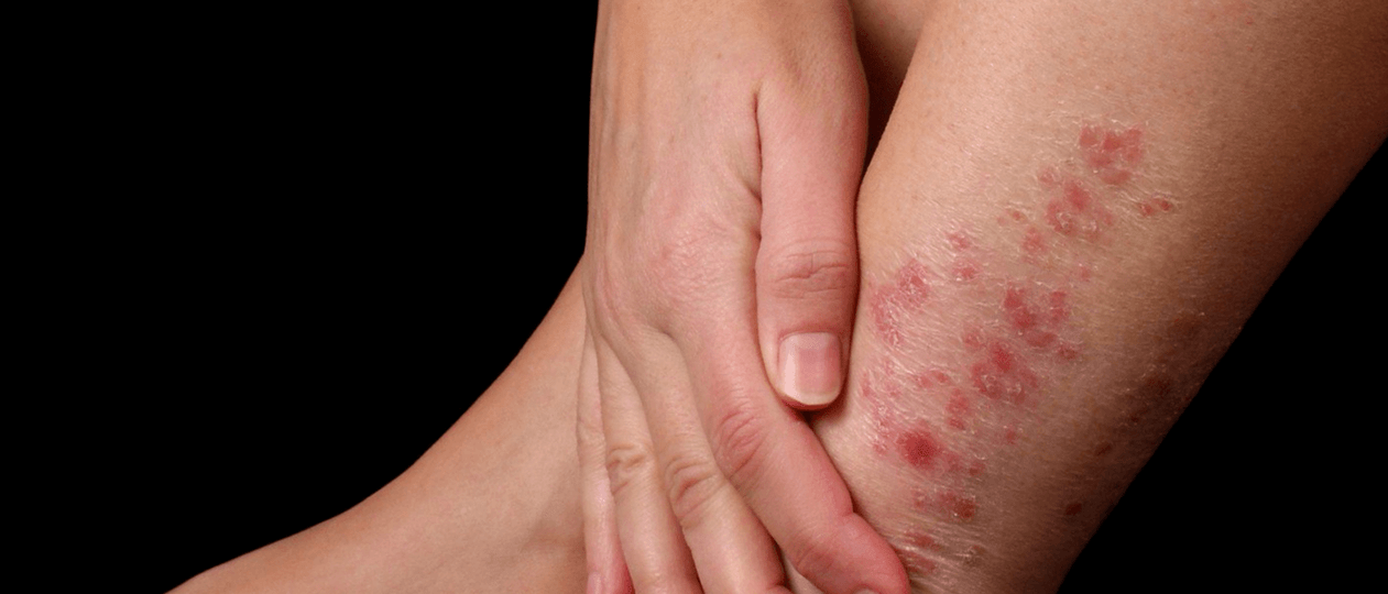 Plaques psoriasis on the skin of the feet
