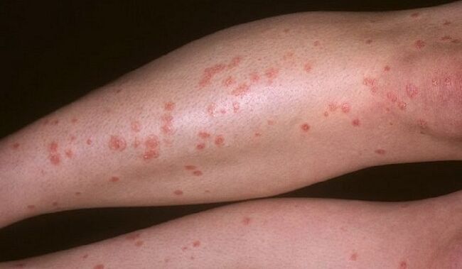 tearful psoriasis of the legs