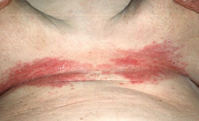 Psoriatic plaques below the breast
