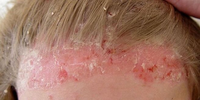 symptoms of psoriasis of the head