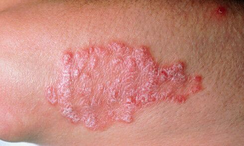 psoriasis of the skin photo 2
