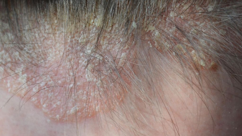 psoriasis of the head photo 4