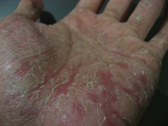 psoriasis on the palm