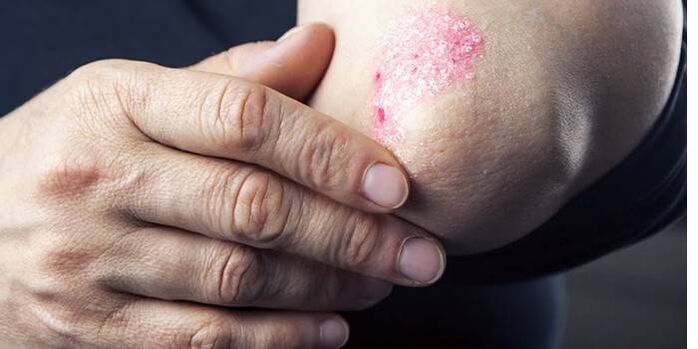 symptoms of psoriasis on the elbows