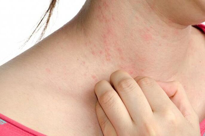Worsening of psoriasis is manifested by skin rashes and severe itching