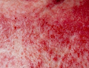 An advanced form of psoriasis