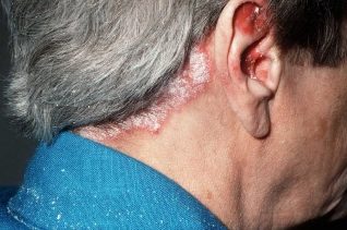 Psoriasis of the head