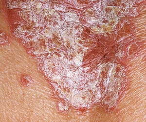 Stationary phase of psoriasis